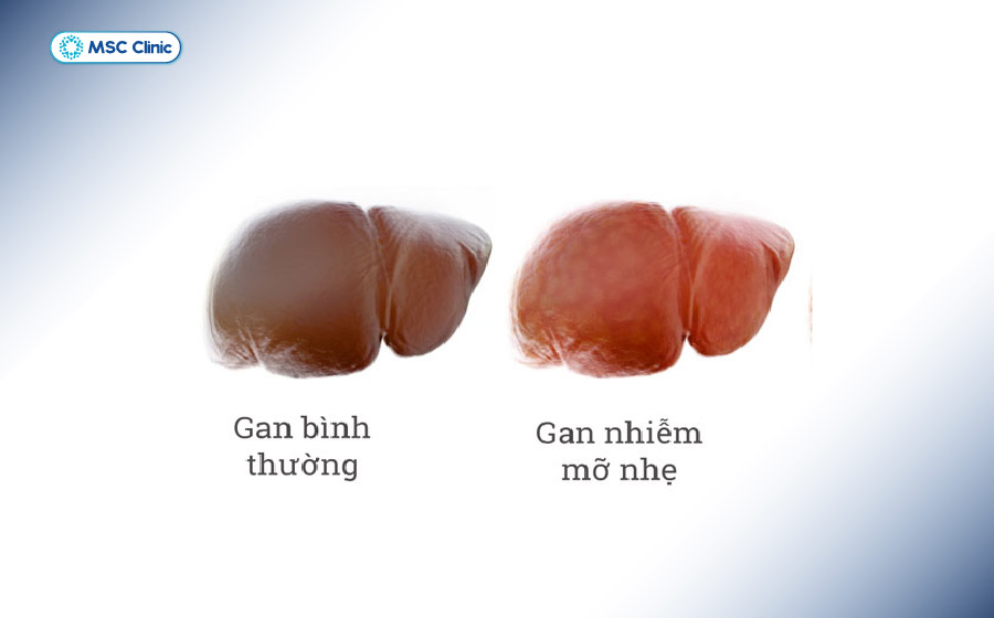 Gan nhiễm mỡ cấp độ 1 là giai đoạn lượng mỡ trong gan mới tăng ở mức nhẹ 