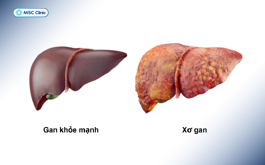 Gan nhiễm mỡ có thể dẫn tới biến chứng xơ gan