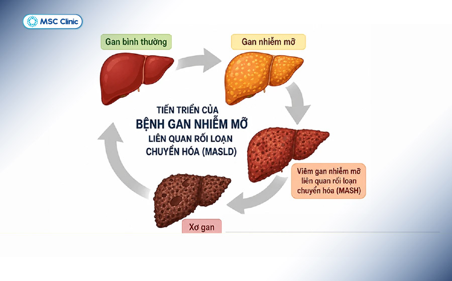 Gan nhiễm mỡ có thể tiến triển âm thầm từ tích tụ mỡ đơn thuần sang viêm gan nhiễm mỡ (MASH) và xơ gan Gan nhiễm mỡ có thể tiến triển âm thầm từ tích tụ mỡ đơn thuần sang viêm gan nhiễm mỡ (MASH) và xơ gan
