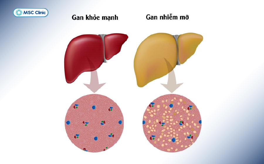 Gan nhiễm mỡ có thể xuất hiện ở nhiều thành viên trong cùng một gia đình 