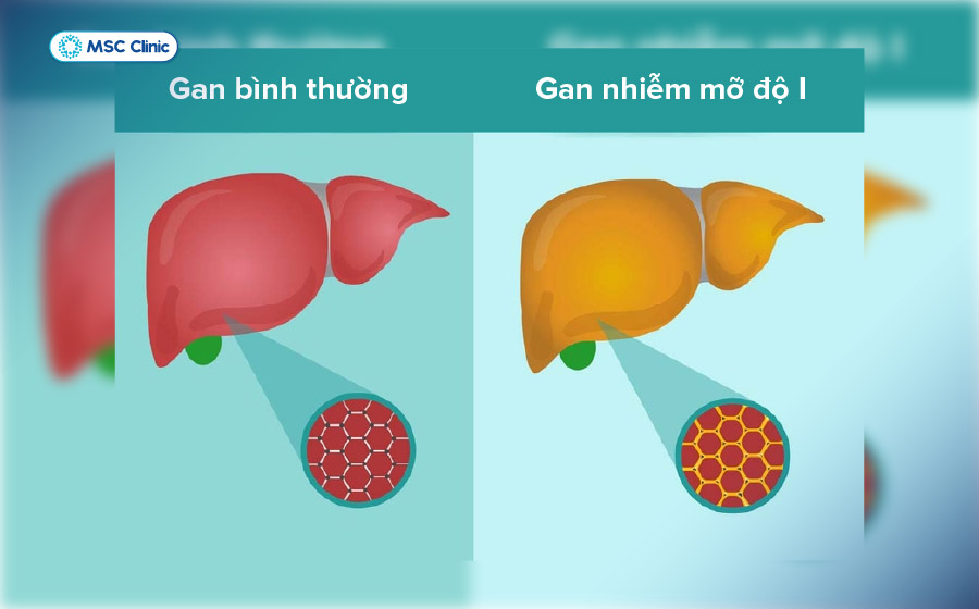 Gan nhiễm mỡ độ 1 thường tiến triển âm thầm và được phát hiện tình cờ khi kiểm tra sức khỏe