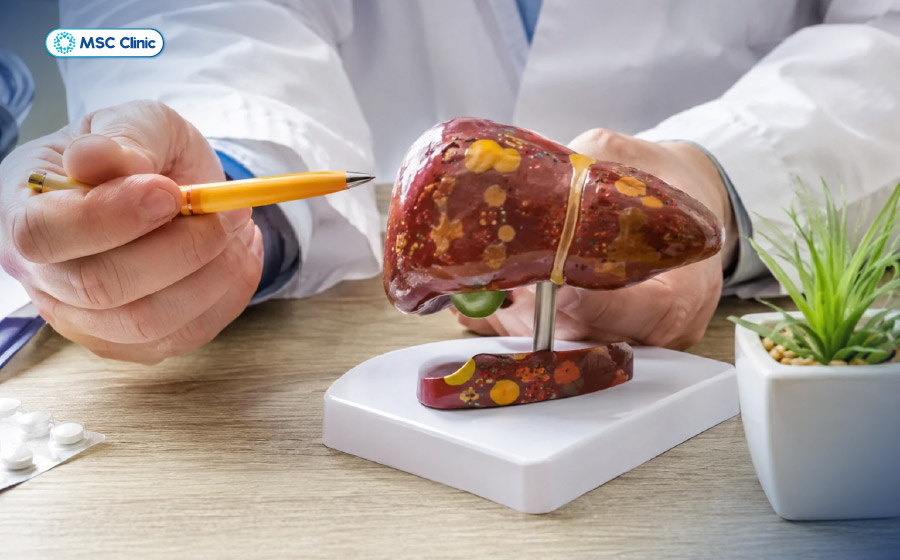 Gan nhiễm mỡ độ 2 là tình trạng cần được điều trị y tế