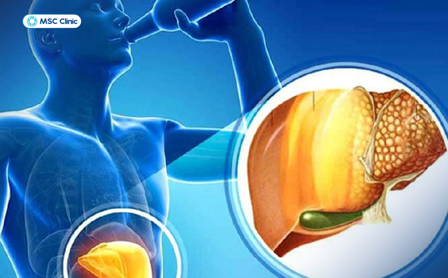 Gan nhiễm mỡ do rượu thường gặp ở nam giới trung tuổi