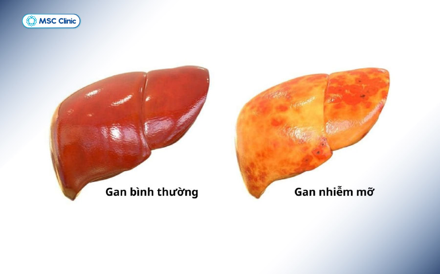 Hình ảnh so sánh gan bình thường và gan nhiễm mỡ - nguyên nhân phổ biến gây men gan cao Hình ảnh so sánh gan bình thường và gan nhiễm mỡ - nguyên nhân phổ biến gây men gan cao