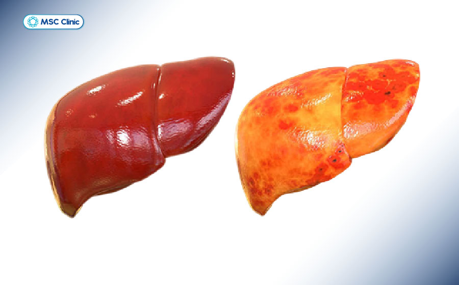 Hình ảnh so sánh gan nhiễm mỡ và gan khỏe mạnh Hình ảnh so sánh gan nhiễm mỡ và gan khỏe mạnh