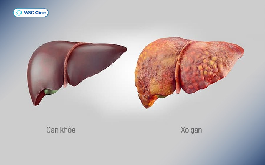 Hình ảnh thể hiện sự khác biệt giữa gan khỏe mạnh và tình trạng xơ gan