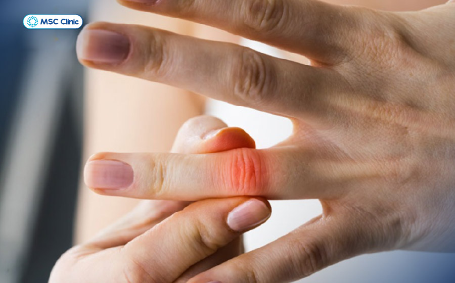 Khớp ngón tay bị bong gân và sưng đau do chịu lực mạnh Khớp ngón tay bị bong gân và sưng đau do chịu lực mạnh