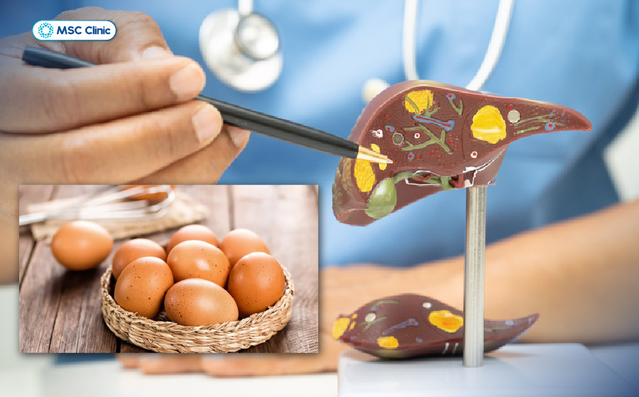 Men gan cao có ăn được trứng gà không? Phần lớn trường hợp vẫn có thể ăn với lượng phù hợp Men gan cao có ăn được trứng gà không? Phần lớn trường hợp vẫn có thể ăn với lượng phù hợp