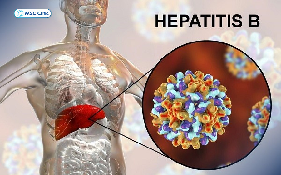 Men gan cao là bệnh gì - có thể do tổn thương vì virus viêm gan
