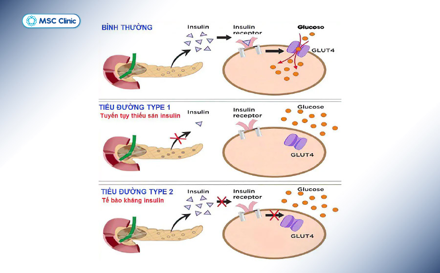 Mỗi tuýp tiểu đường sẽ có cơ chế bệnh sinh và hướng điều trị khác nhau