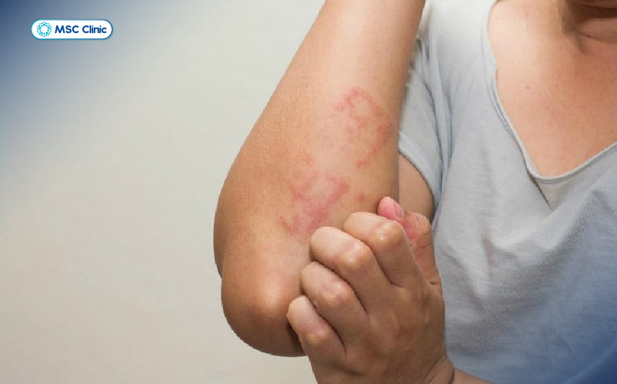 Một số bệnh nhiễm trùng và ký sinh trùng có thể gây tổn thương gan mạn tính, biểu hiện qua các dấu hiệu ngoài da Một số bệnh nhiễm trùng và ký sinh trùng có thể gây tổn thương gan mạn tính, biểu hiện qua các dấu hiệu ngoài da