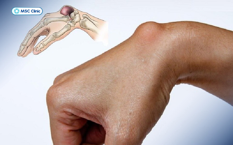 Người bị viêm bao hoạt dịch có sưng đau, cứng tại vị trí khớp bị tổn thương