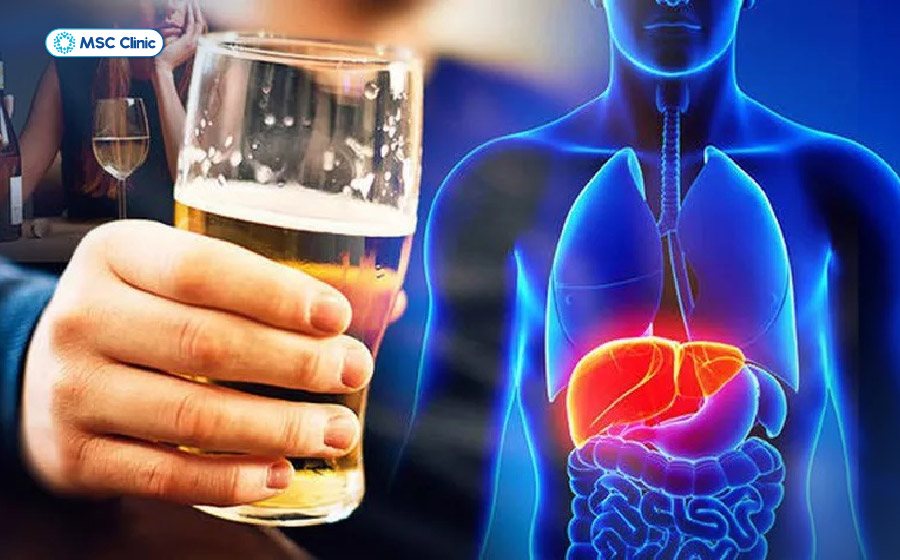 Người có men gan cao nên hạn chế, tốt nhất là tránh hoàn toàn rượu bia để giảm thêm áp lực lên gan và hỗ trợ quá trình phục hồi Người có men gan cao nên hạn chế, tốt nhất là tránh hoàn toàn rượu bia để giảm thêm áp lực lên gan và hỗ trợ quá trình phục hồi