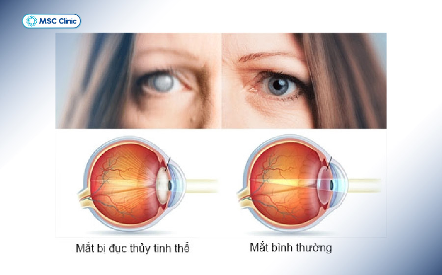 Người mắc tiểu đường có nguy cơ đục thủy tinh thể sớm hơn và thường xuyên hơn