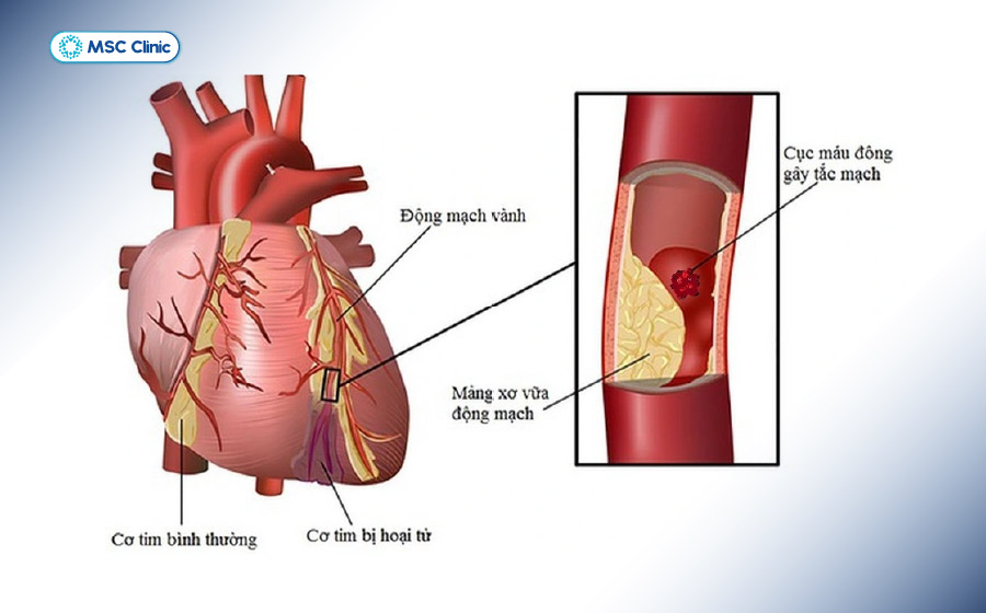 Người tiểu đường có nguy cơ cao bị nhồi máu cơ tim, đột quỵ