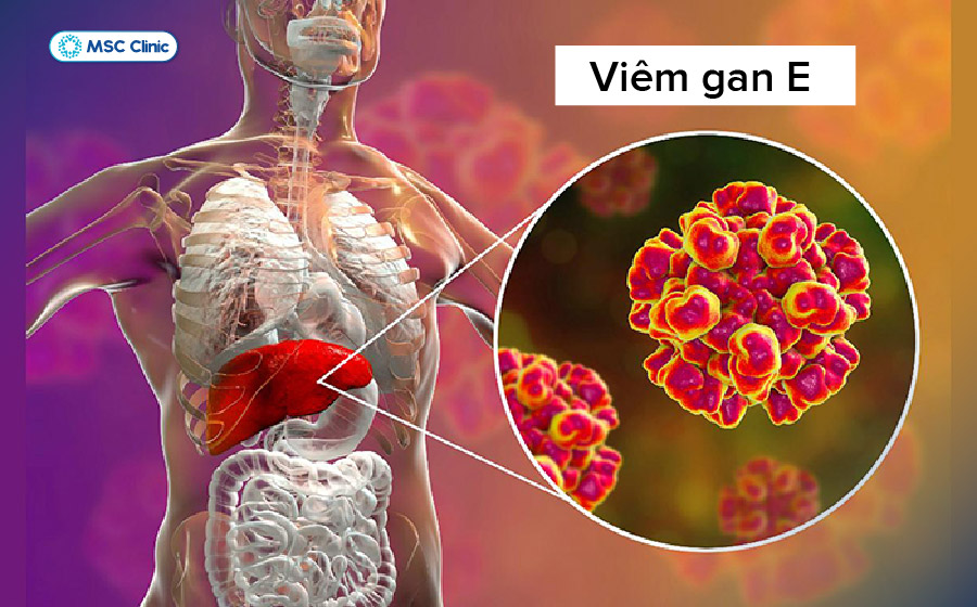 Nhiễm virus viêm gan E là một trong những nguyên nhân có thể gây tổn thương gan và suy gan cấp tính