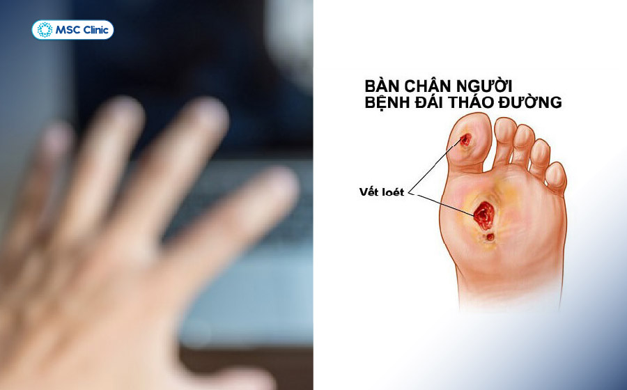 Nhìn mờ hoặc vết thương lâu lành có thể là dấu hiệu biến chứng tiểu đường
