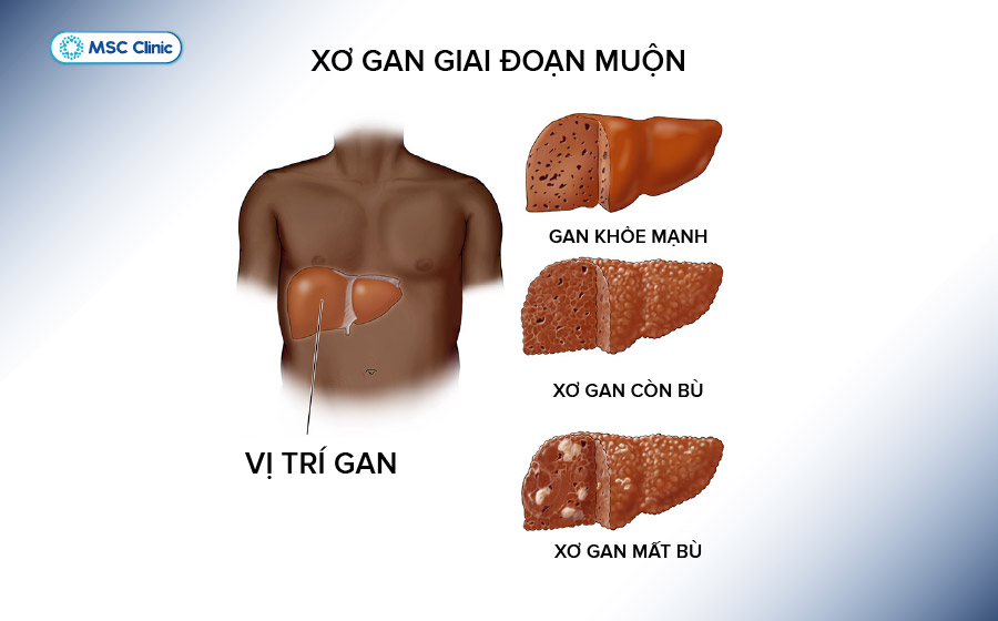 So sánh mô gan khỏe mạnh và tình trạng tổn thương ở xơ gan giai đoạn cuối 