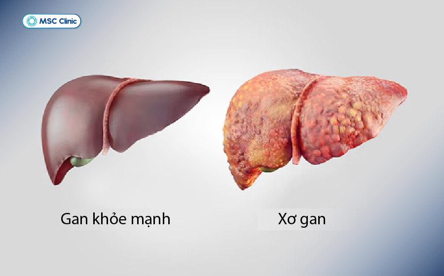 Sự khác biệt giữa gan khỏe mạnh và xơ gan với các mô sẹo Sự khác biệt giữa gan khỏe mạnh và xơ gan với các mô sẹo