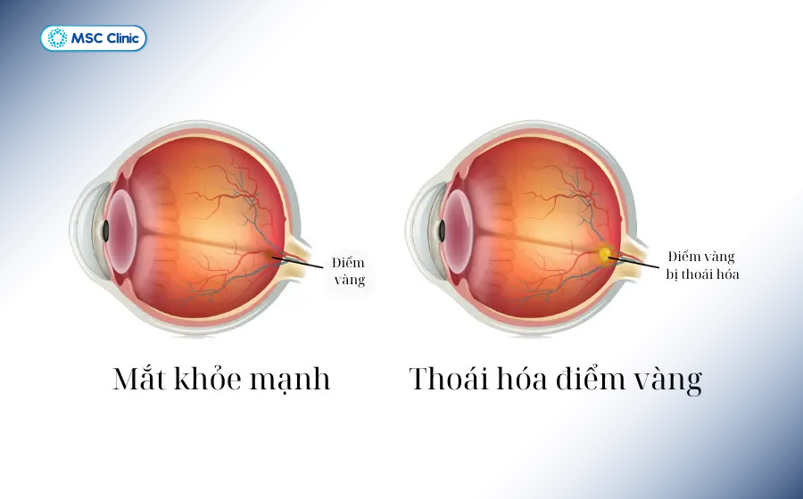 Thoái hóa điểm vàng làm suy giảm thị lực trung tâm