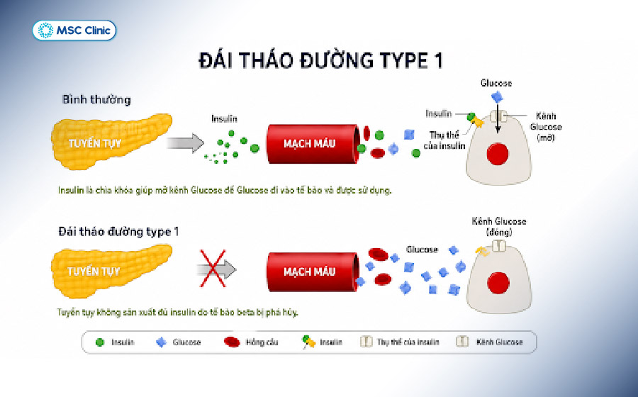 Tiểu đường type 1 xảy ra khi cơ thể thiếu insulin do tế bào beta tuyến tụy bị tổn thương bởi nguyên nhân tự miễn