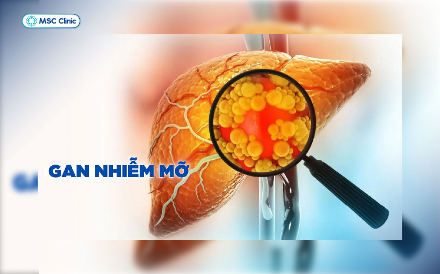 Tình trạng tích tụ quá nhiều chất béo trong mô gan gây nên tình trạng gan nhiễm mỡ Tình trạng tích tụ quá nhiều chất béo trong mô gan gây nên tình trạng gan nhiễm mỡ