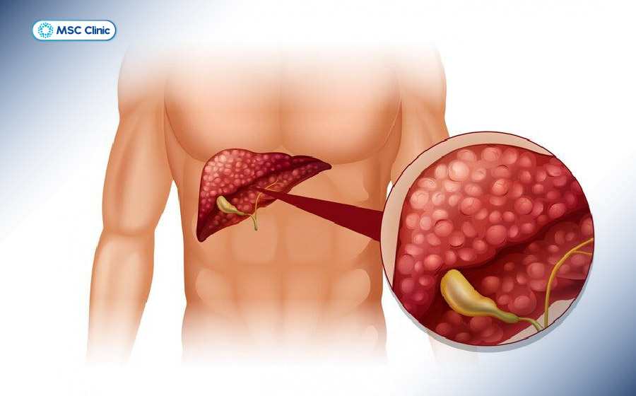 Ung thư gan - một trong những nguyên nhân nghiêm trọng có thể đe dọa chức năng gan và gây suy gan cấp 