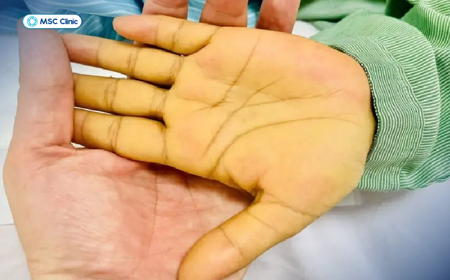 Vàng da là dấu hiệu dễ nhận thấy của tình trạng xơ gan giai đoạn 3