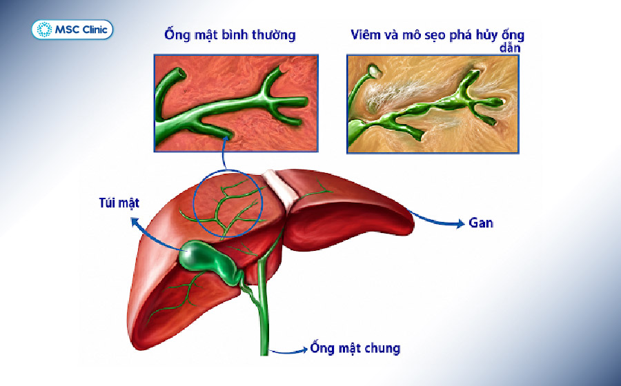 Viêm đường mật xơ hóa nguyên phát có thể dẫn tới men gan cao