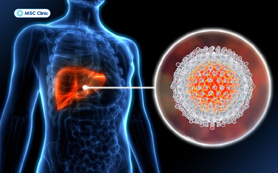 Viêm gan virus kéo dài không được điều trị có thể tiến triển thành tổn thương xơ gan giai đoạn cuối 