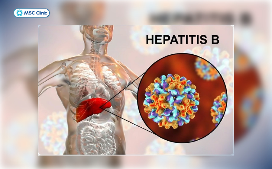 Viêm gan virus mạn tính như viêm gan B có thể là nguyên nhân gây xơ gan