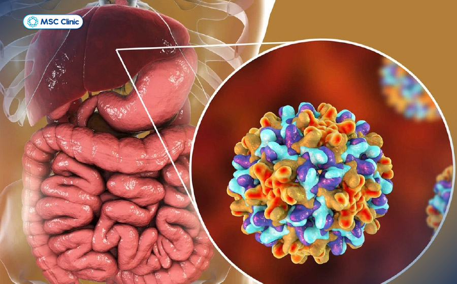 Virus viêm gan B, C có thể lây truyền từ người sang người và chuyển thành xơ gan