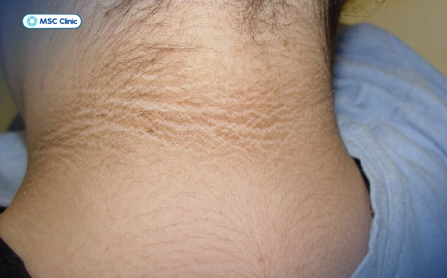 Vùng da sẫm màu ở sau cổ thường gặp ở người bị kháng insulin Vùng da sẫm màu ở sau cổ thường gặp ở người bị kháng insulin