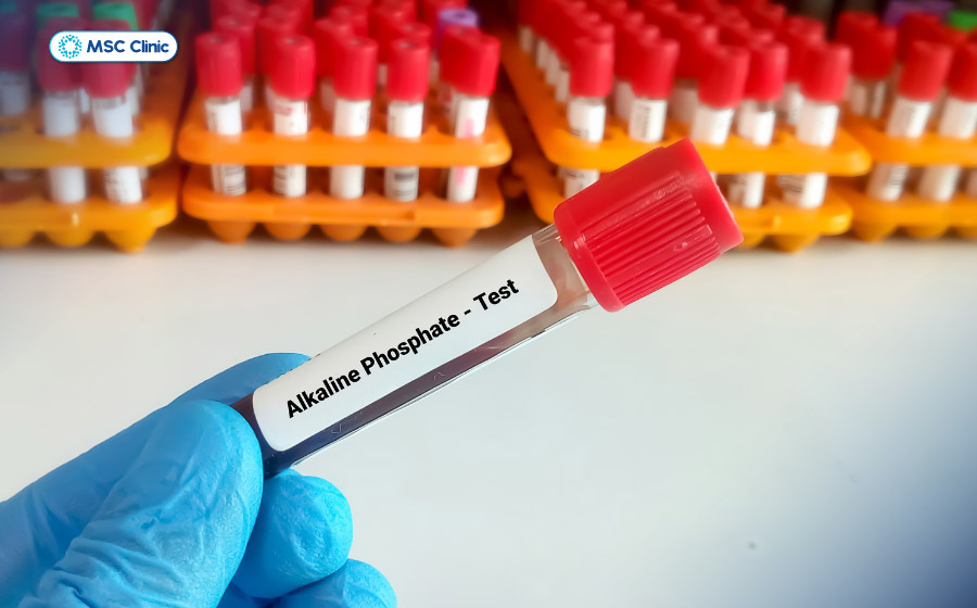 Xét nghiệm Alkaline Phosphatase (ALP) hỗ trợ đánh giá các bất thường liên quan đến hệ đường mật và bệnh lý về xương