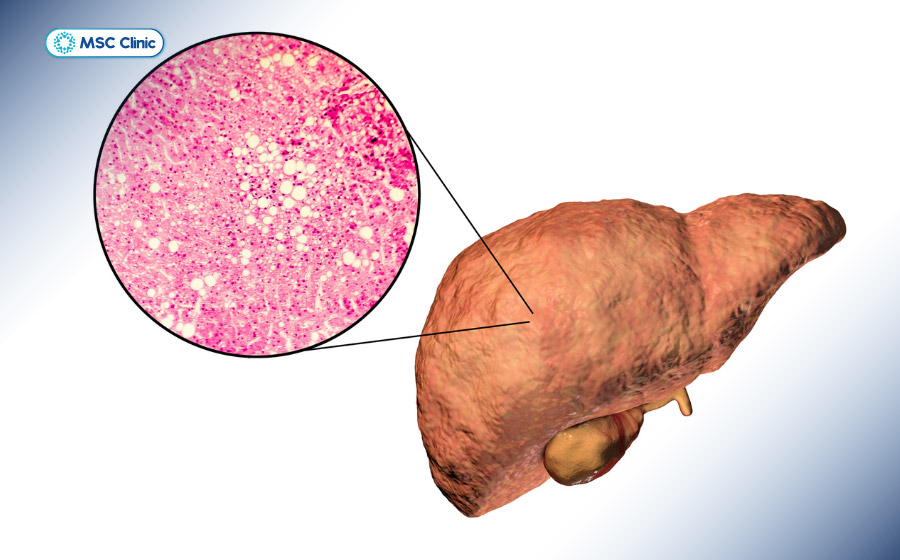 Xét nghiệm men gan hỗ trợ nhận biết sớm các mức độ tổn thương và suy giảm chức năng tế bào gan