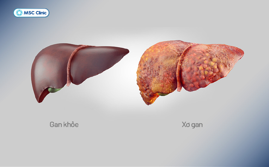 Xơ gan có mấy giai đoạn là vấn đề được nhiều người quan tâm khi tìm hiểu tiến triển bệnh