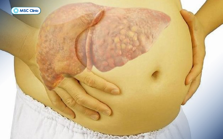 Xơ gan nếu không được điều trị kịp thời sẽ gây ra nhiều biến chứng nguy hiểm ảnh hưởng đến sức khỏe và tính mạng của người bệnh