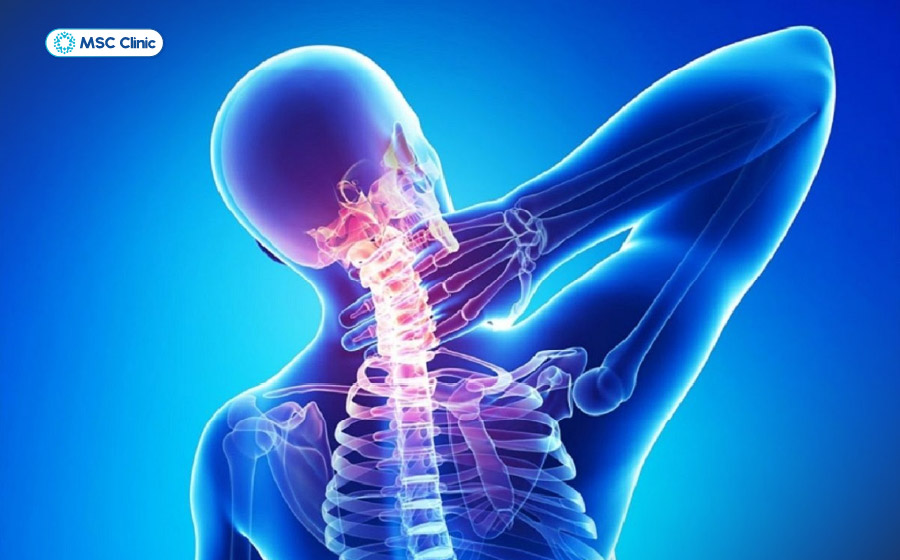 Xoay cổ kêu lạo xạo là một trong số các dấu hiệu của thoái hóa đốt sống cổ