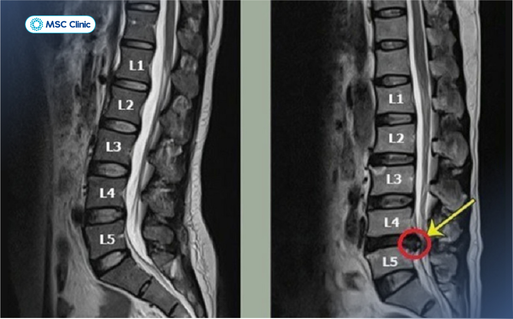 Thoát vị L4-L5 có thể kích thích hoặc chèn ép rễ thần kinh, gây đau và tê lan xuống chân 