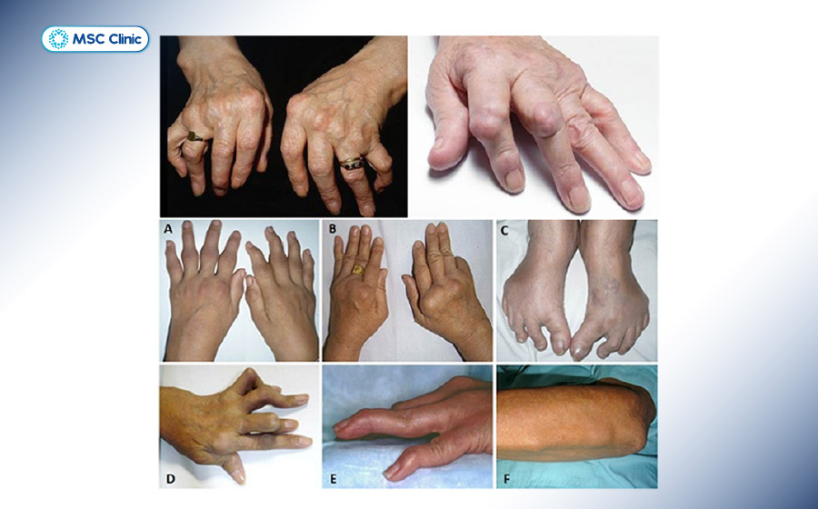 Bệnh lý thấp khớp có thể liên quan đến miễn dịch, thoái hóa, rối loạn chuyển hóa và nhiều yếu tố khác