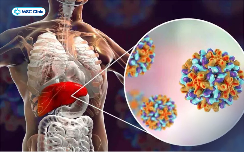 Phản ứng miễn dịch của cơ thể chống lại virus HBV gây ra tổn thương tế bào gan