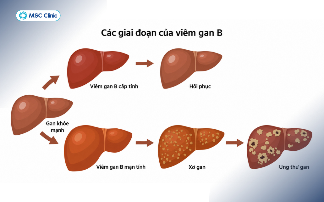 Các giai đoạn tiến triển của viêm gan B