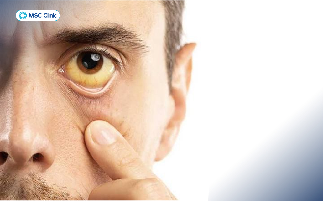 Ở giai đoạn cấp tính, người bệnh có thể xuất hiện dấu hiệu vàng mắt