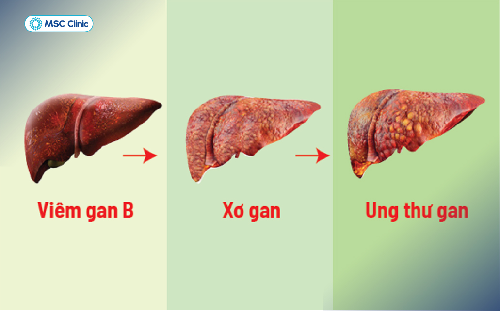 Tổn thương gan mạn tính do HBV làm tăng nguy cơ tiến triển thành xơ gan, ung thư gan