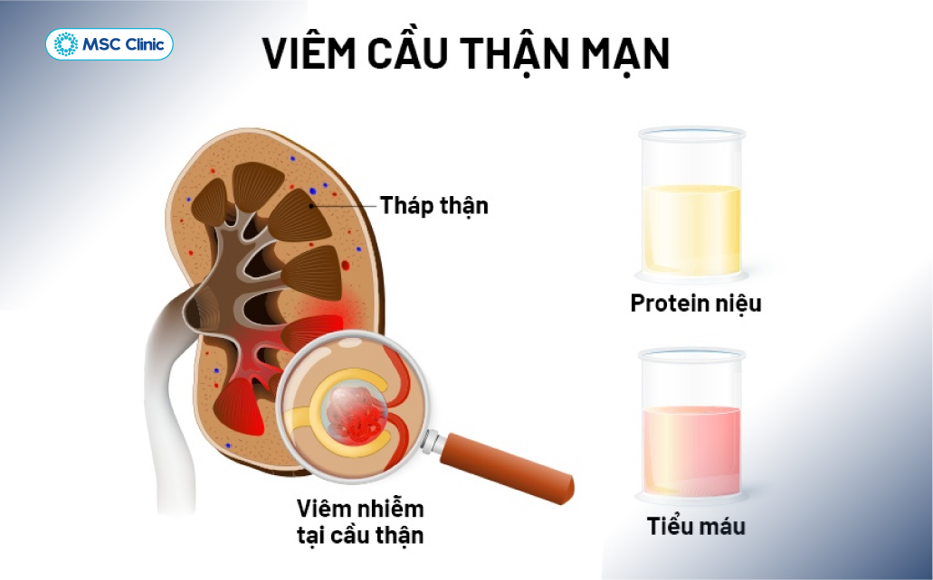 Virus HBV có thể kích hoạt tổn thương tại thận và gây viêm cầu thận