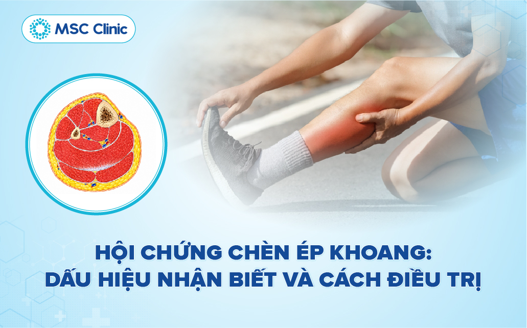 Hội chứng chèn ép khoang: Dấu hiệu nhận biết và cách điều trị