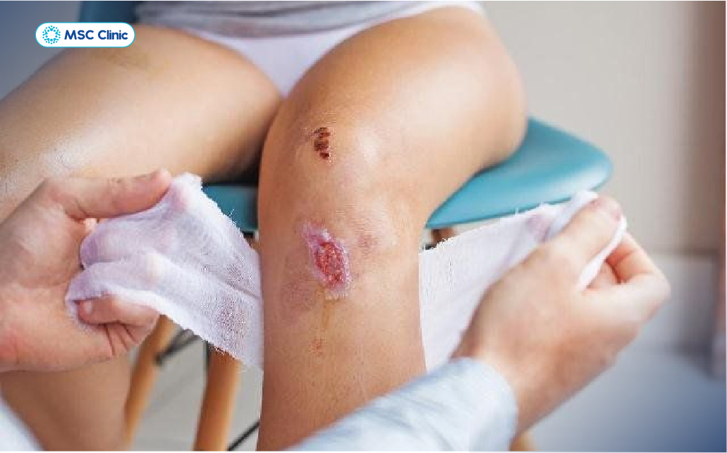 Hội chứng chèn ép khoang không điều trị kịp thời có thể dẫn tới hoại tử và phải cắt cụt chi