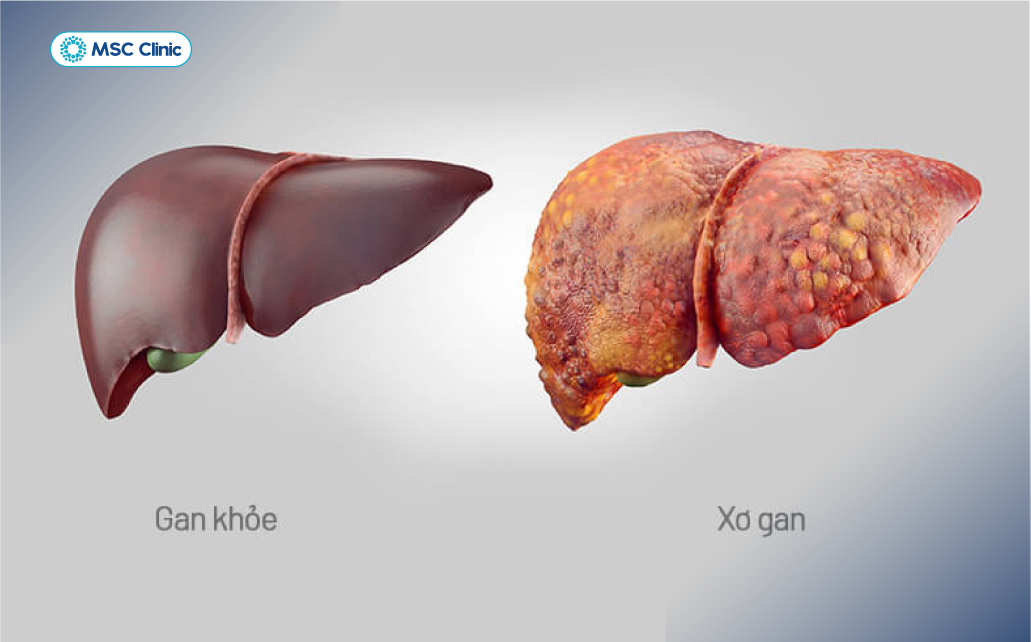 Xơ gan gây tổn thương tế bào gan và chức năng gan