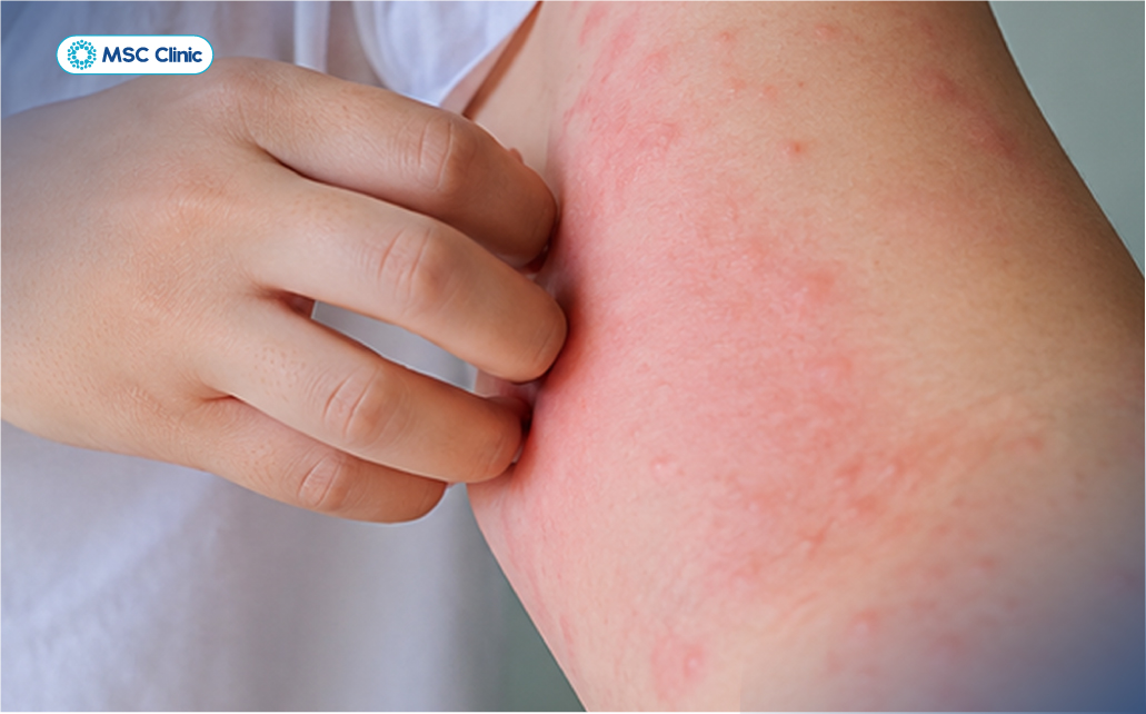 Ngứa ngáy, nổi mề đay là các dấu hiệu nóng gan điển hình
