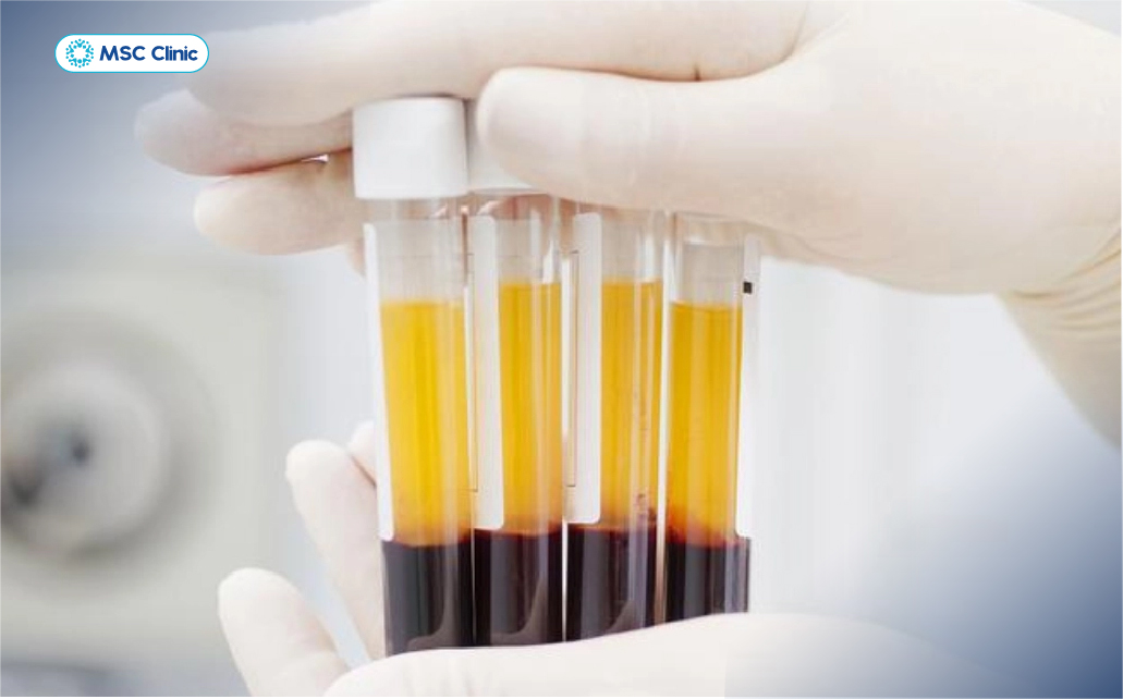 PRP là liệu pháp giảm viêm an toàn, hạn chế tác dụng phụ PRP là liệu pháp giảm viêm an toàn, hạn chế tác dụng phụ